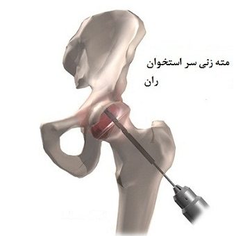 درمان نکروز یا سیاه شدن سر استخوان ران
